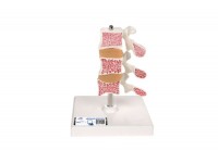 zestaw dysków zawiasowych - 4 szt. osteoporoza - 1019509 3b scientific modele anatomiczne 10